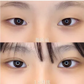 TCB二重埋没の症例写真