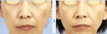 湘南美容クリニックのピコレーザー症例写真