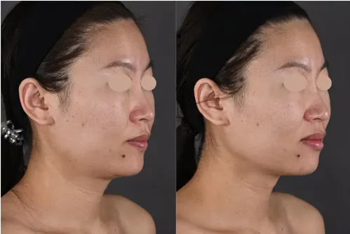 横浜で安いおすすめモフィウス8の症例写真1