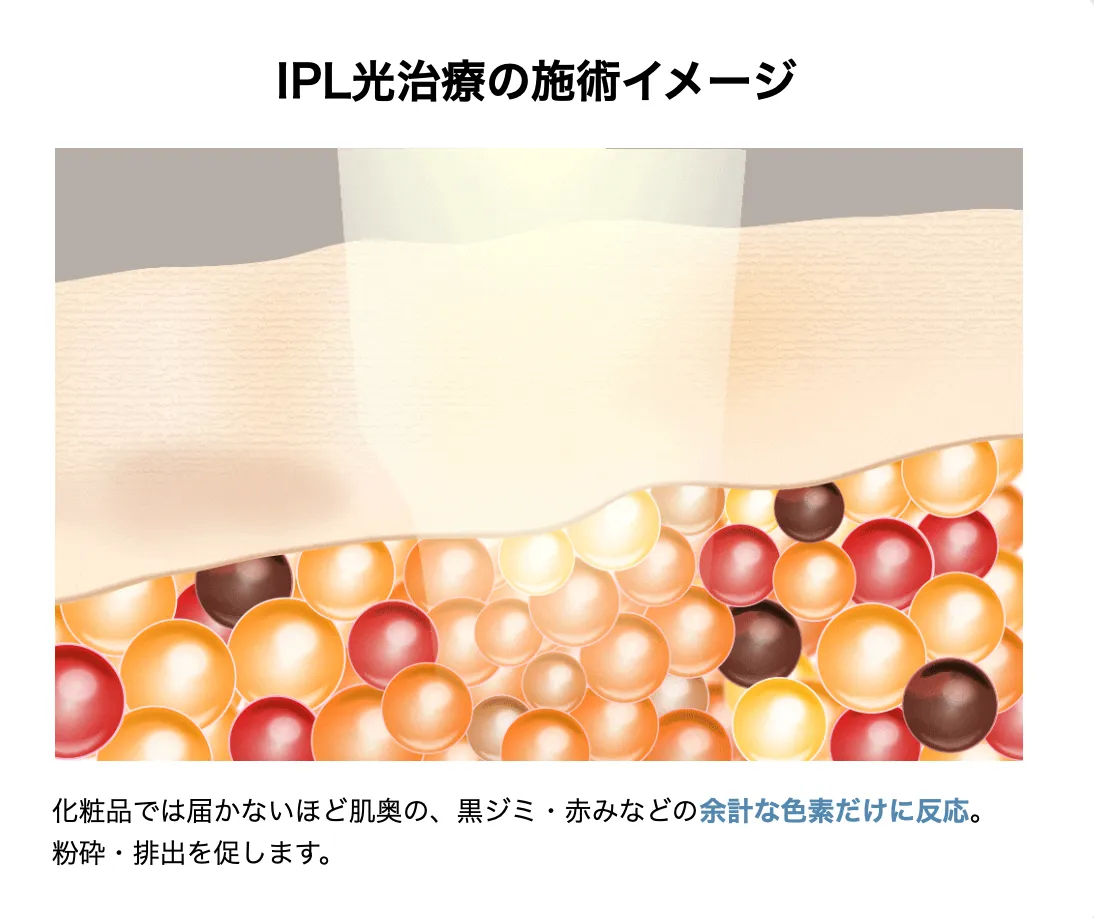 湘南美容クリニックのメンズシミ取り施術のイメージ