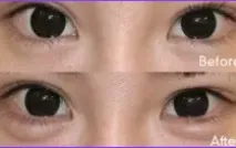 湘南美容クリニックの涙袋形成③