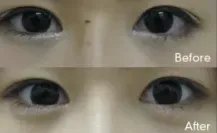 湘南美容クリニックの涙袋形成④