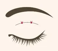 二重整形埋没法