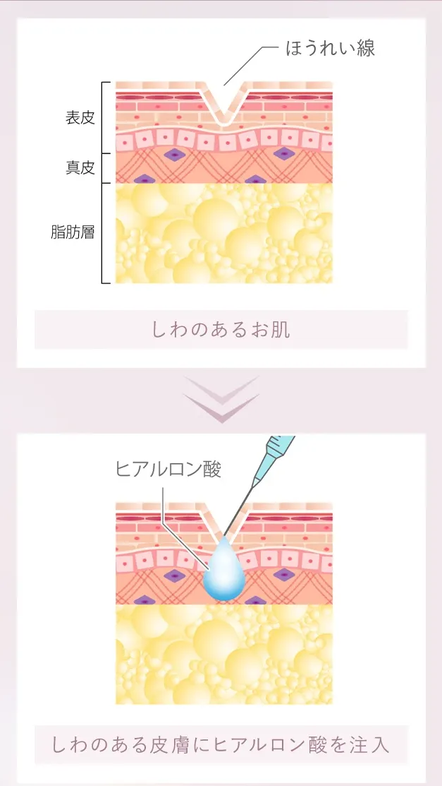 TCBのヒアルロン酸注射の仕組み
