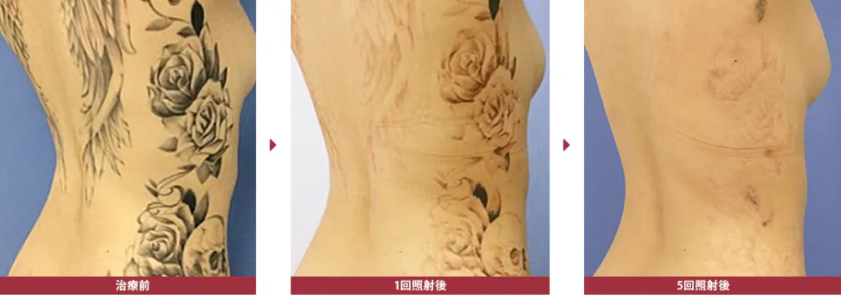 湘南美容クリニックのタトゥー除去(刺青除去)の症例