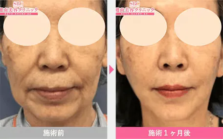 SBCのリフトアップの症例