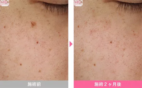 SBCのシミ取りの症例