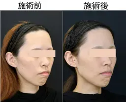 湘南美容クリニックのヒアルロン酸注入の症例