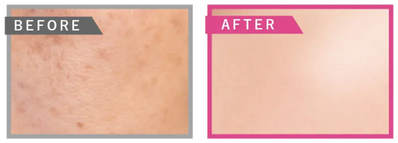 ビューティスクリニックのピコトーニングの口コミ評判　症例写真