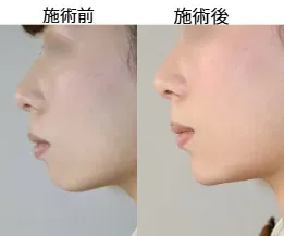 湘南美容クリニックのヒアルロン酸注入の症例