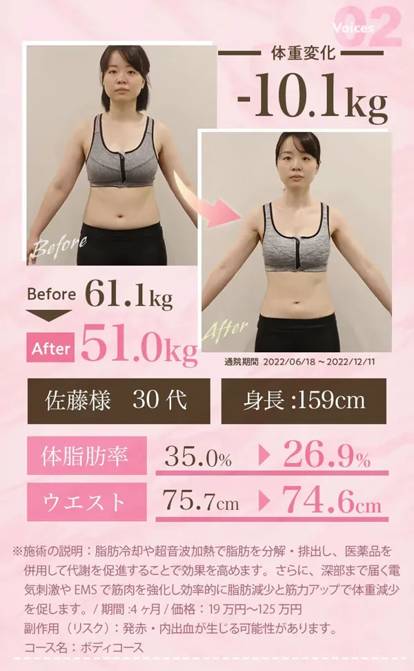 脂肪冷却のキャンペーン一覧！モニター無料　症例写真②