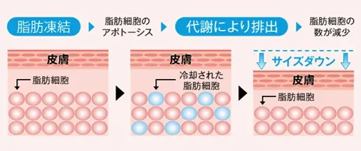 脂肪冷却のキャンペーン一覧！モニター無料　施術