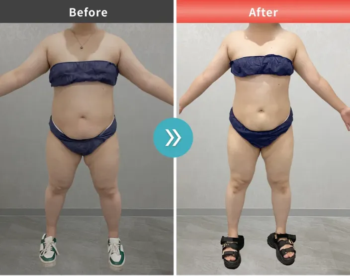 脂肪冷却のキャンペーン一覧！モニター無料　症例写真③