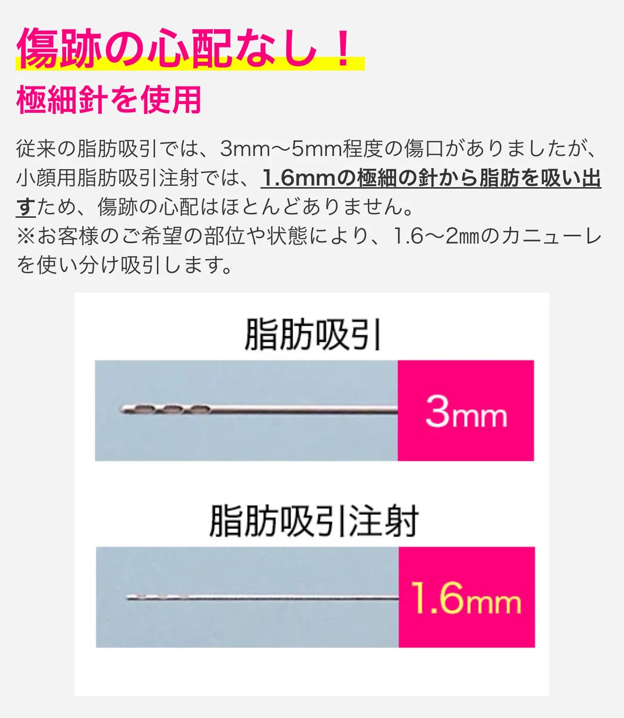 湘南美容クリニックの小顔脂肪吸引注射は、極細針を使用しているため、傷跡の心配なし!
