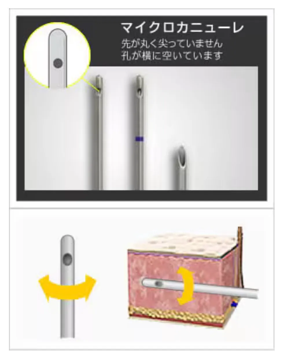 湘南美容クリニックの脂肪溶解注射(BNLSアルティメット)で使用するマイクロカニューレの図解