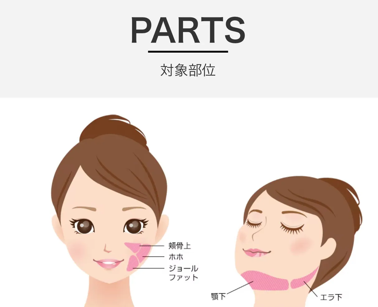湘南美容クリニックの小顔脂肪吸引注射の対象部位