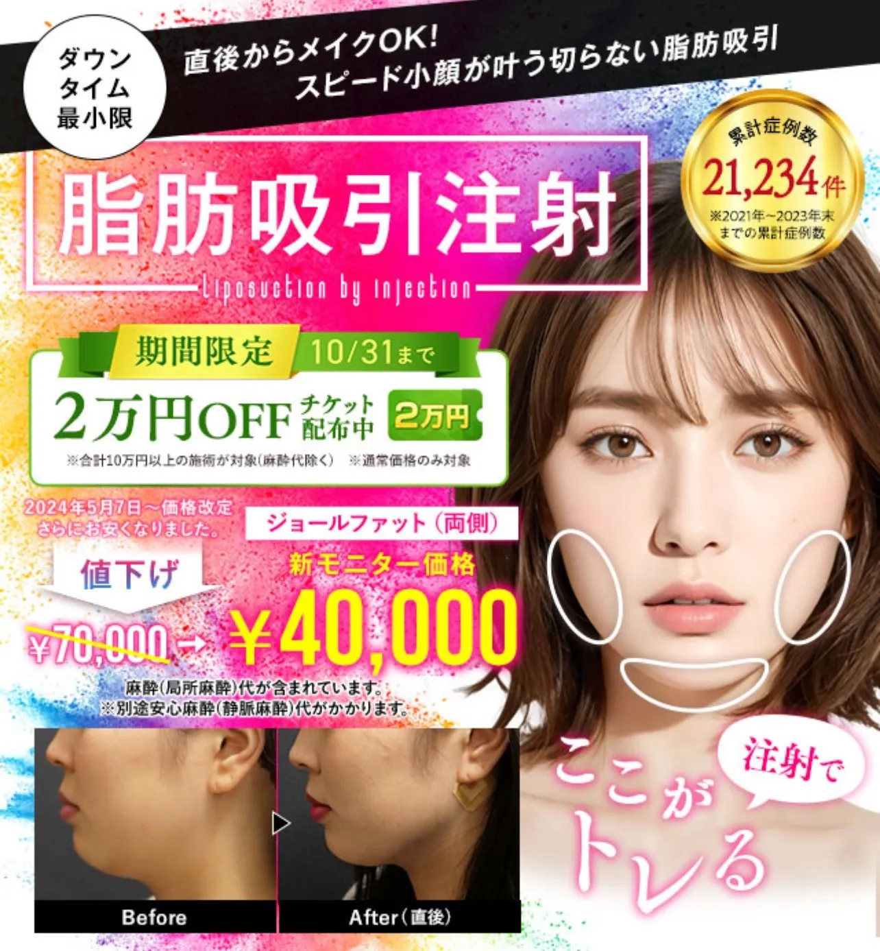 湘南美容クリニックの小顔脂肪吸引注射