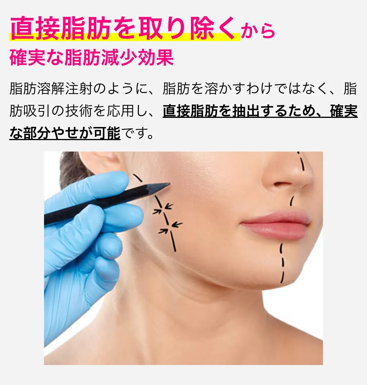 湘南美容クリニックの小顔脂肪吸引注射は、直接脂肪を抽出するため確実に部分やせが可能