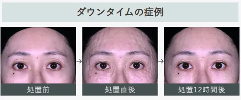湘南美容クリニックの女優注射のダウンタイム経過