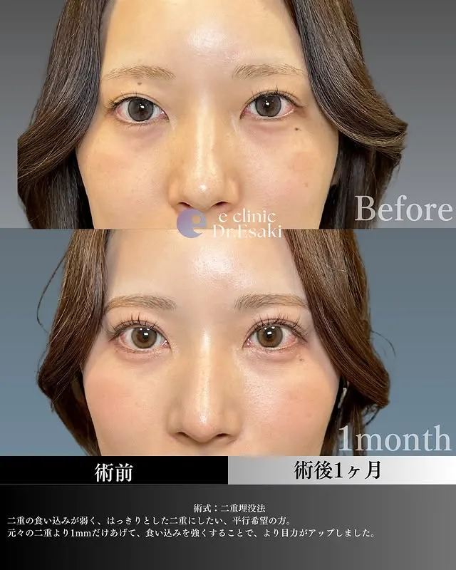 eクリニック江崎正俊医師の二重埋没の症例