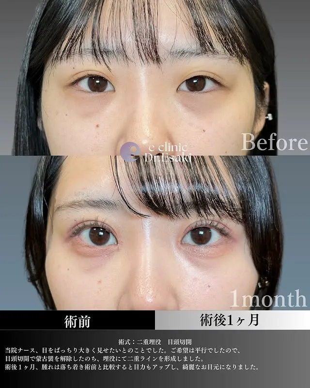 TCBの二重埋没の症例