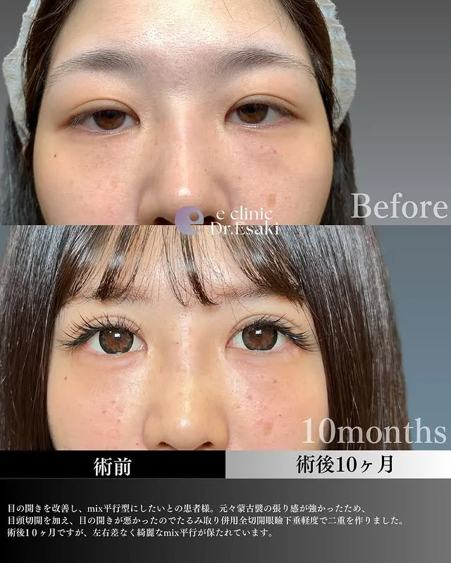 TCBの二重埋没の症例