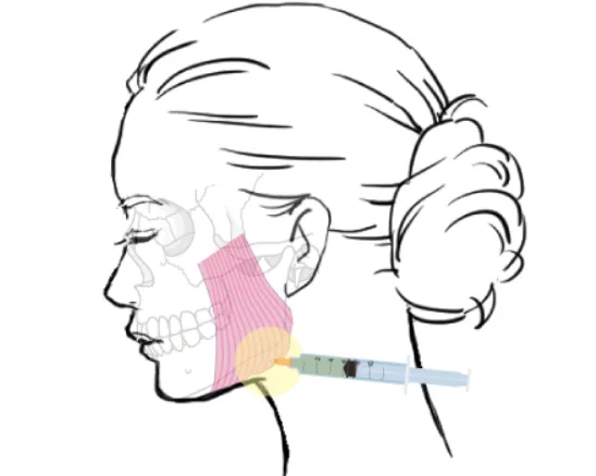 エラボトックスの施術部位