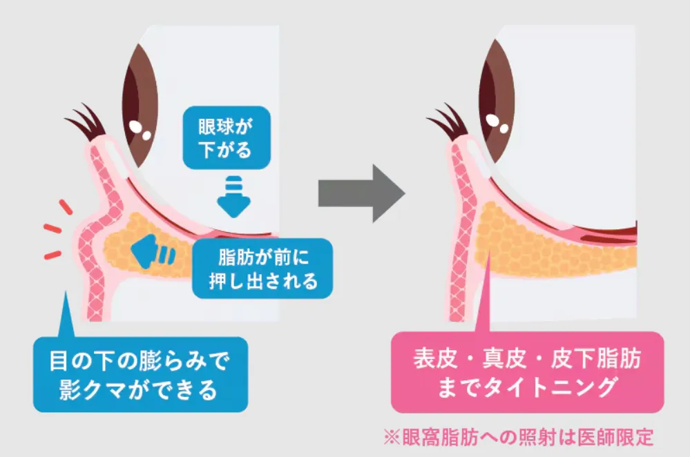 福岡でおすすめの安いモフィウス８は眼科脂肪にアプローチ可能