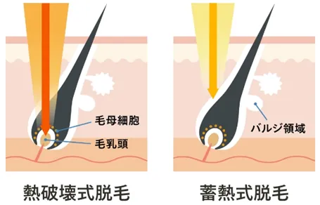ジェントルマックスプロを導入している医療脱毛クリニック 特徴