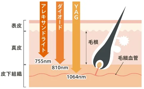 ジェントルマックスプロを導入している医療脱毛クリニック レーザー