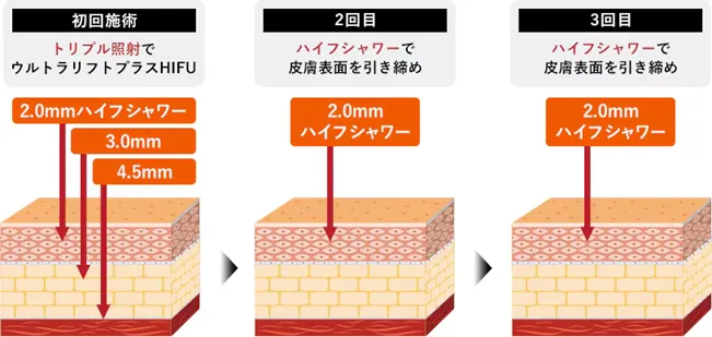 医療ハイフの安いおすすめ人気クリニック 湘南美容クリニックのプレミアムセット