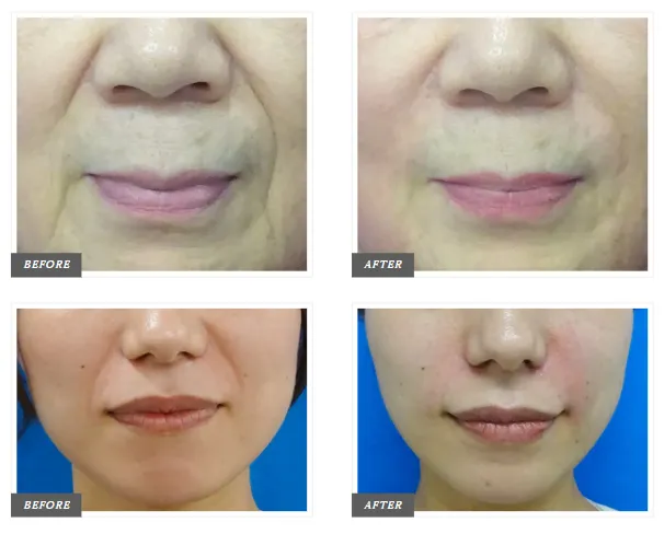 大阪でヒアルロン酸注射を受けられるおすすめのクリニックTCBのほうれい線症例