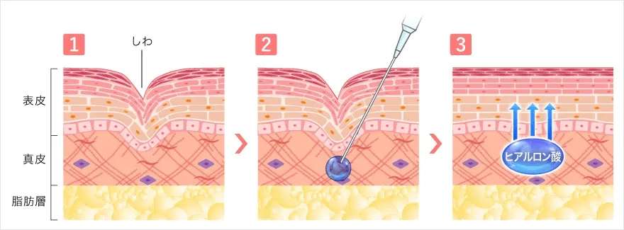 当記事がおすすめするTCBのヒアルロン酸注射のイメージ画像