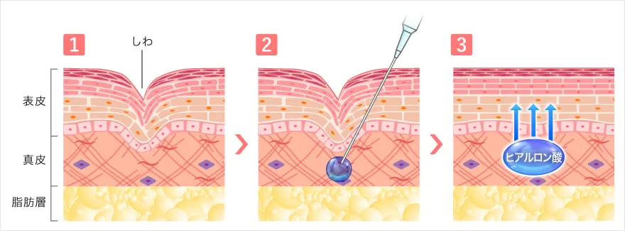 TCBのヒアルロン酸注射の仕組み