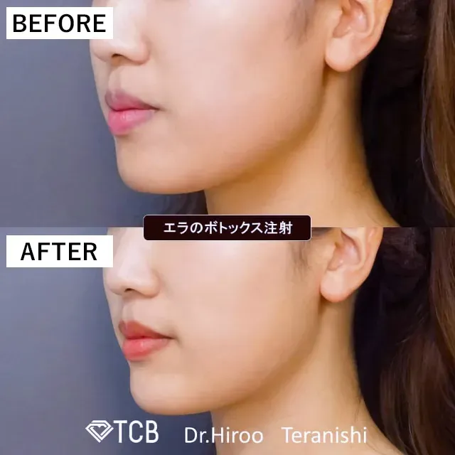 編集部が札幌でおすすめするTCBのエラボトックス症例