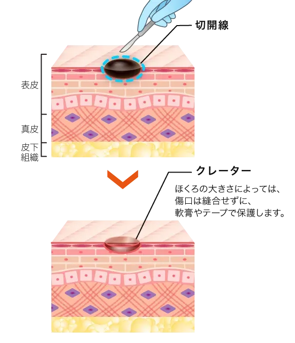 ほくろ除去のくり抜き法