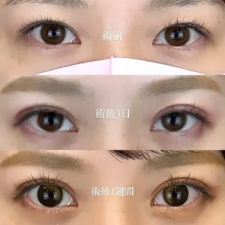 口コミ・レビューが高いTCB渋谷東口院の二重症例写真