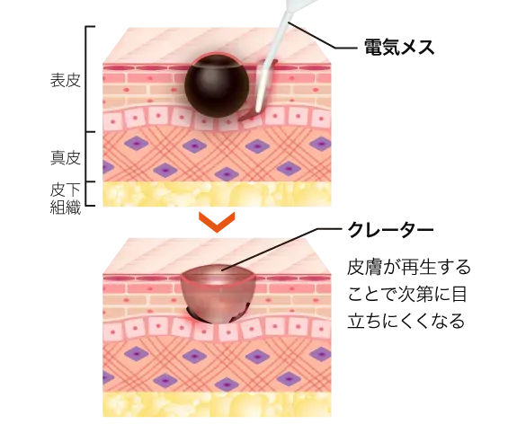ほくろ除去の電気メス治療