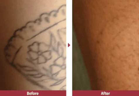 湘南美容クリニックの安いタトゥー除去(刺青除去)の症例1