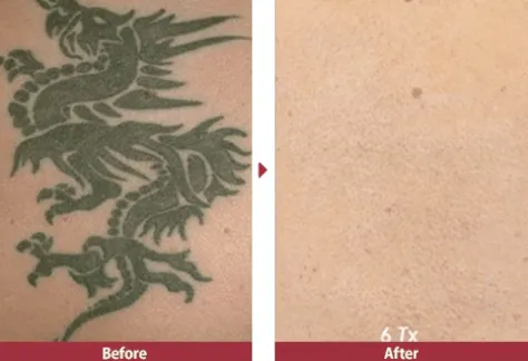 湘南美容クリニックの安いタトゥー除去(刺青除去)の症例2