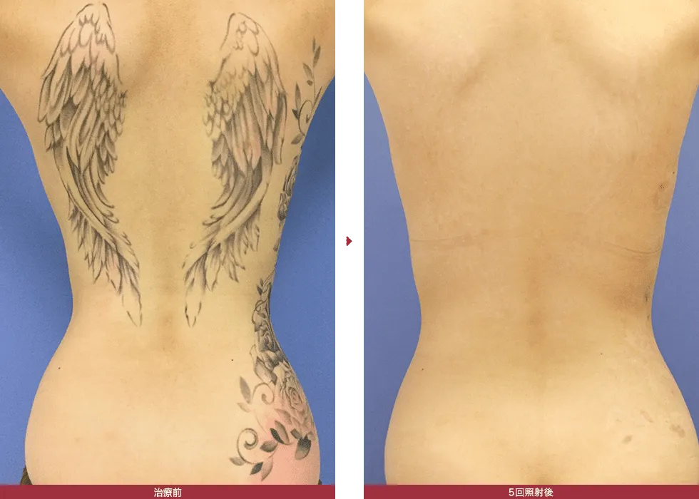 湘南美容クリニックのタトゥー除去(刺青除去)の症例写真