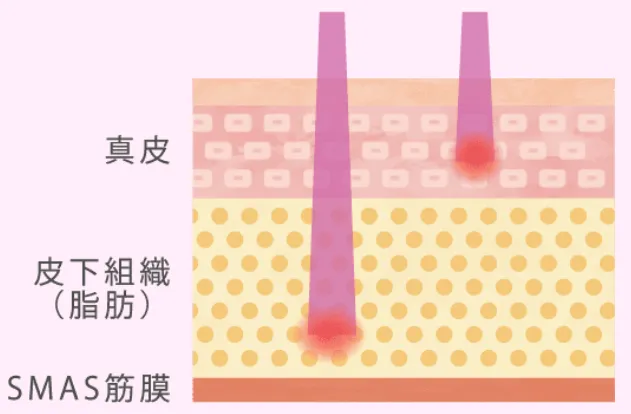インモードの仕組み