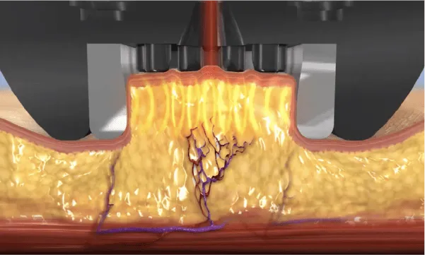 インモード ミニFX