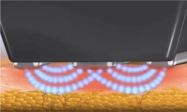 インモード フォーマ