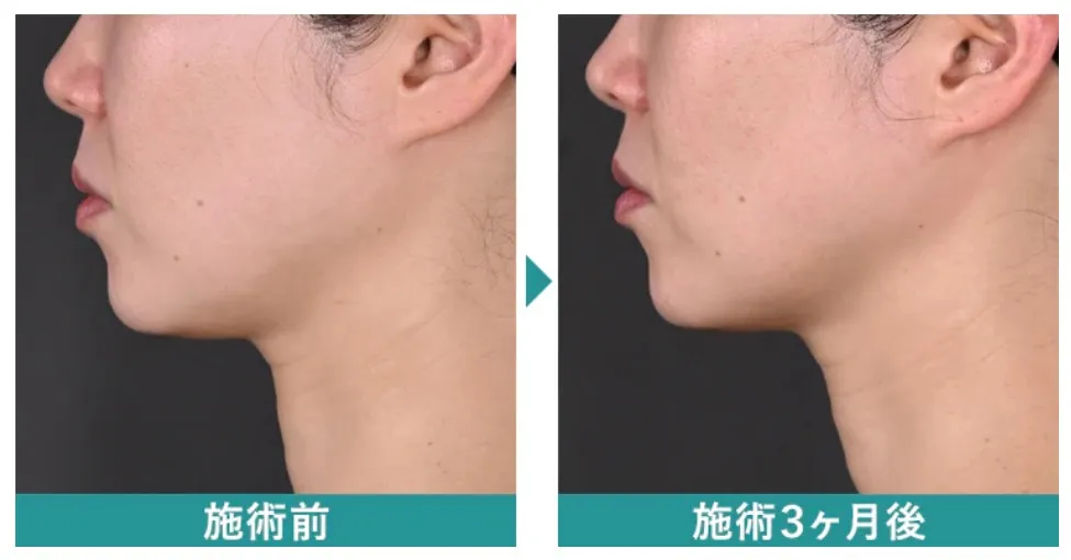 湘南美容クリニックのデンシティの症例写真