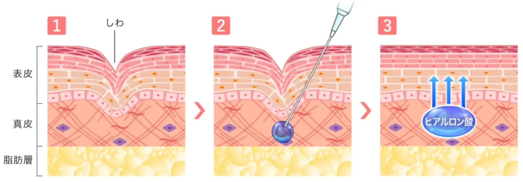 石川(金沢)でヒアルロン酸注射ができるおすすめのクリニック TCBのヒアルロン酸注射についての説明