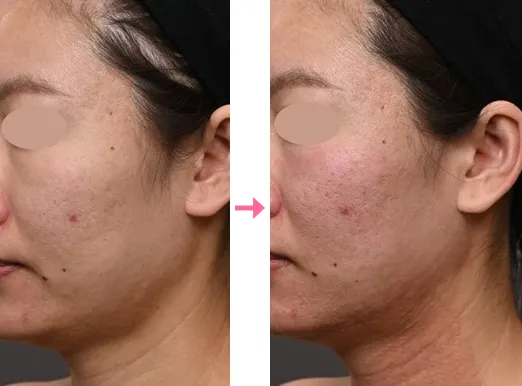 湘南美容クリニックのモフィウス8の症例