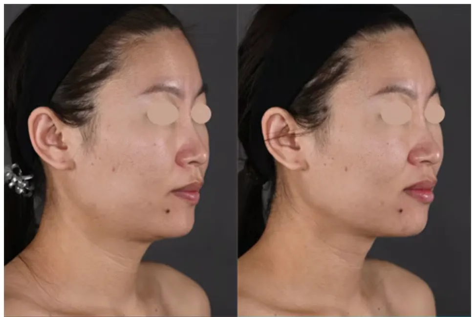 湘南美容クリニックのmモフィウス8の症例