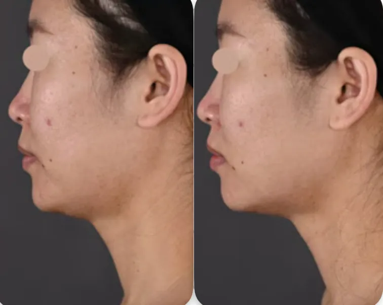 湘南美容クリニックのモフィウス8の症例