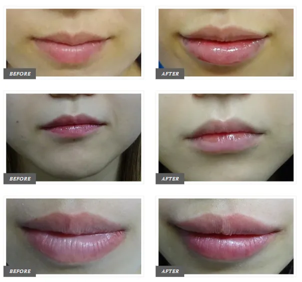 東京でヒアルロン酸注射ができるおすすめのクリニックTCBの症例①